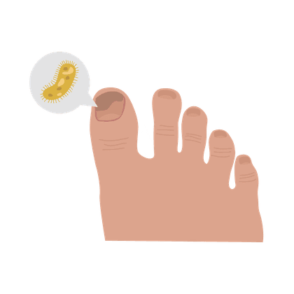 Nagelschimmel (onychomycose) en voetschimmel (voetschimmel)