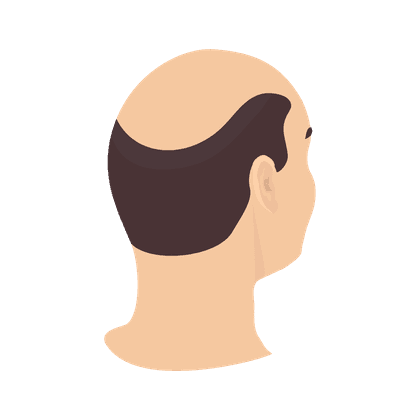 Alopecia (kaalheid, haaruitval)