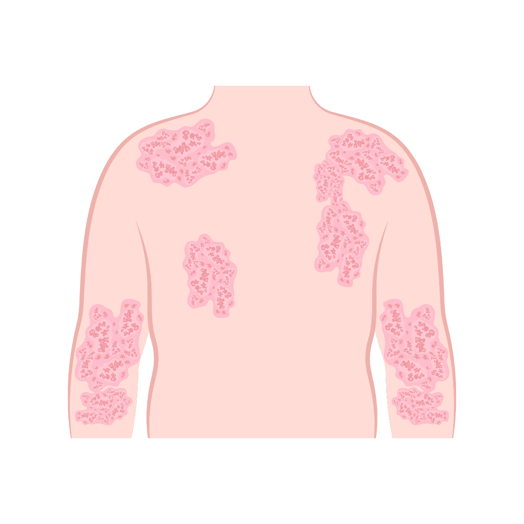 Atopische dermatitis, neurodermitis