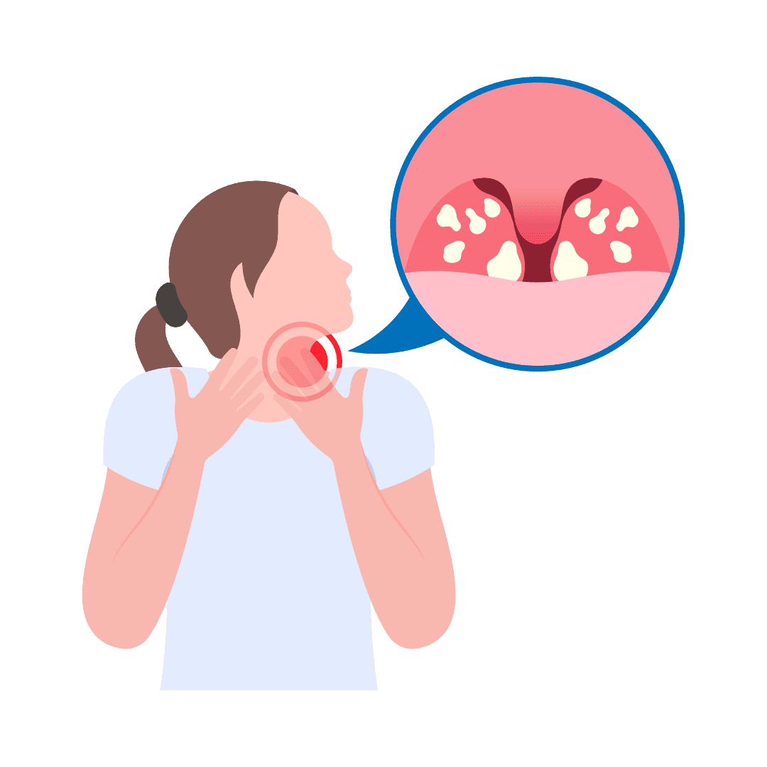 Angina en amandelontsteking
