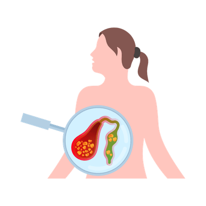 Galstase (cholestase)