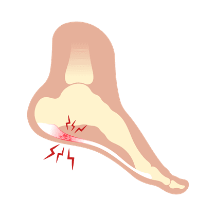 Hielspoor (osteofyt)